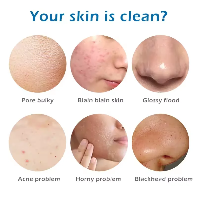 Морская соль, мыло для удаления прыщей на теле - Фотография_5