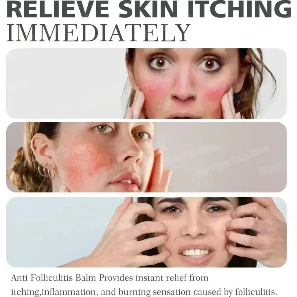 Крем против прыщей эффективно удаляет ножницы кожи - Фотография_2