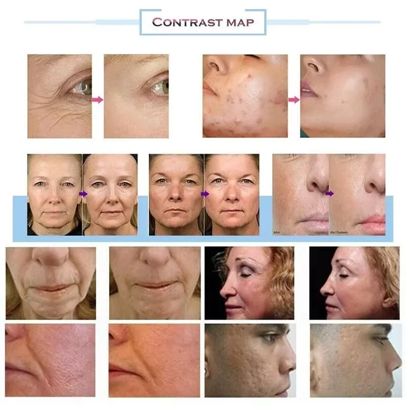 Профессиональный morpheus 8 rf - Фотография_6