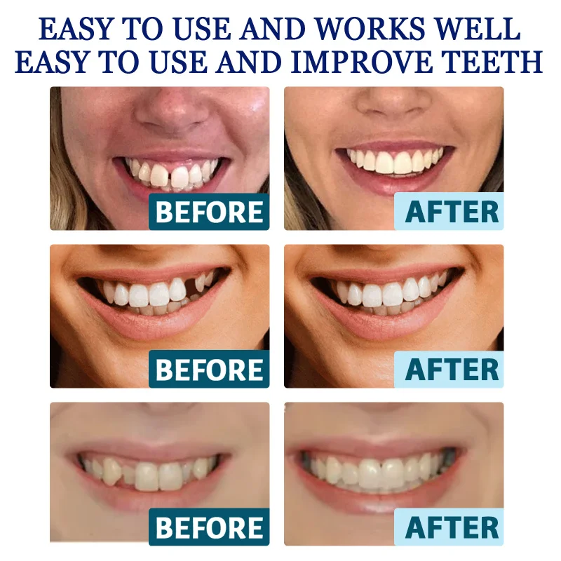 Невидимые выравниватели зубов — - Фотография_6