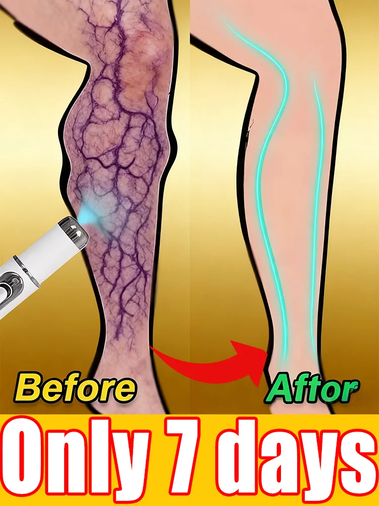 Vᴀʀɪᴄᴏsᴇ ᴠᴇɪɴ ʟᴀsᴇʀ ɪɴsᴛʀᴜᴍᴇɴᴛ