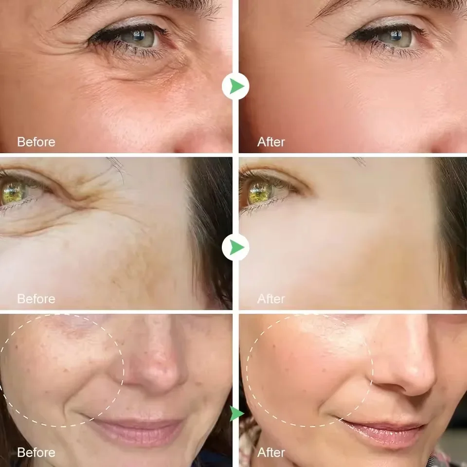 Ретинол, удаление морщин - Фотография_5